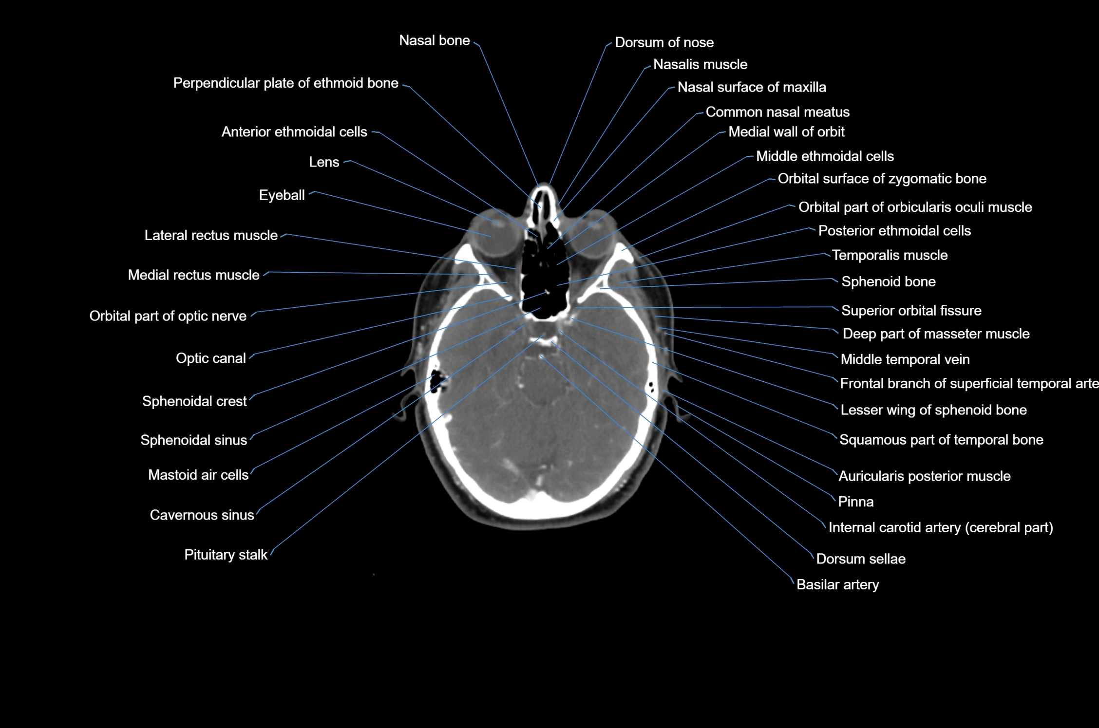 CT Neck axial cross sectional anatomy radiology image-img-00001-00008.webp